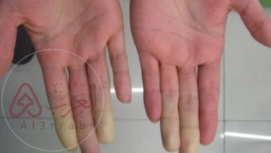 ما هو مرض برجر ويكيبيديا الاعراض وطرق العلاج