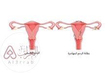 ما هي بطانة الرحم المهاجرة