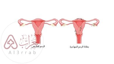 ما هي بطانة الرحم المهاجرة