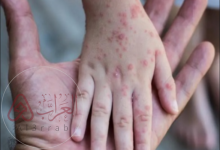 جدري القرود ويكيبيديا أعراضه وأشكاله وطرق انتقاله