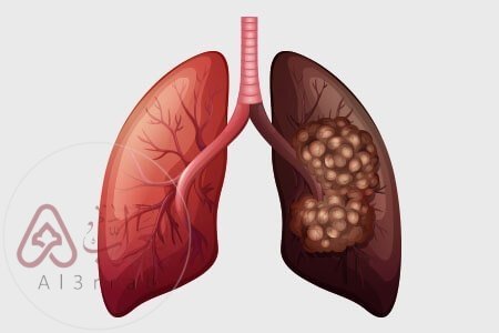 بعض أمراض الرئة واختلالاتها التي لها علاقة بالتدخين